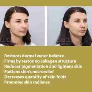 HYALUAL Xela Rederm 1.8