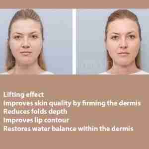 HYALUAL Xela Rederm 2.2 HYALUAL Xela Rederm 2.2