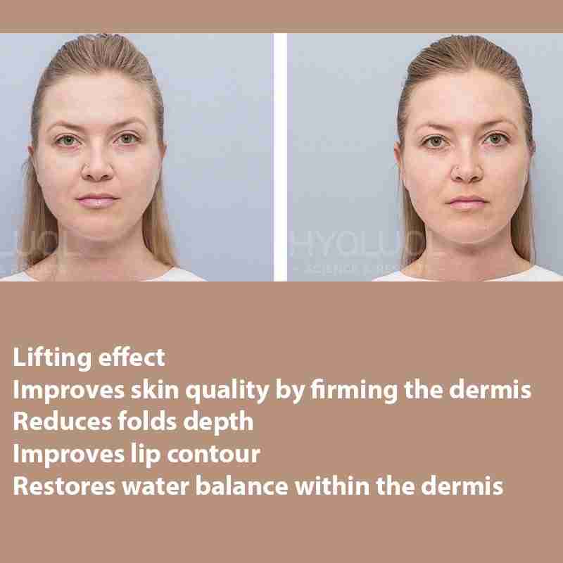 HYALUAL Xela Rederm 2.2 HYALUAL Xela Rederm 2.2