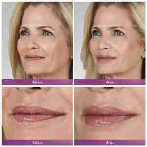 Juvederm ® Ultra 3 with Lidocaine