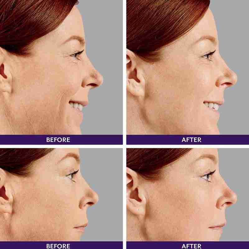 Juvederm ® Ultra 4 with Lidocaine Juvederm ® Ultra 4 with Lidocaine