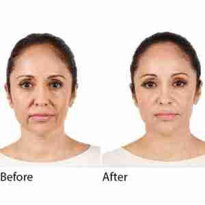 Radiesse Lifting & Volume Filler Radiesse Lifting & Volume Filler