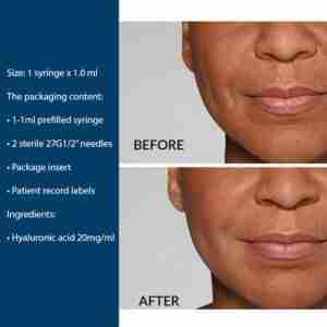 3Restylane® Defyne Lidocaine 3Restylane® Defyne Lidocaine