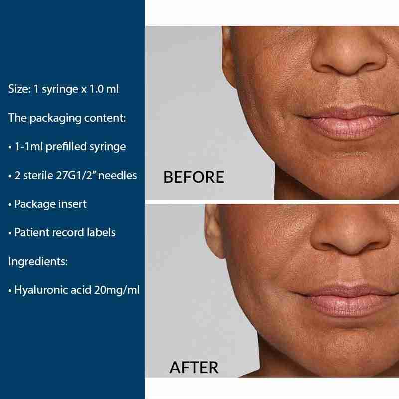 3Restylane® Defyne Lidocaine 3Restylane® Defyne Lidocaine