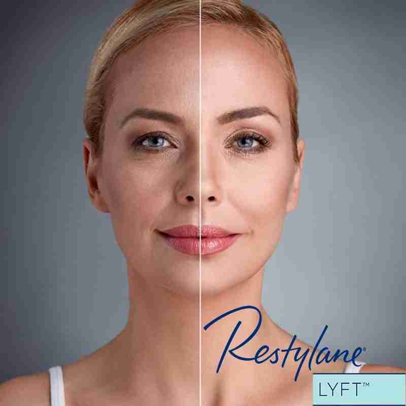 Restylane® Lyft with Lidocaine