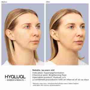 HYALUAL Brightening Peel