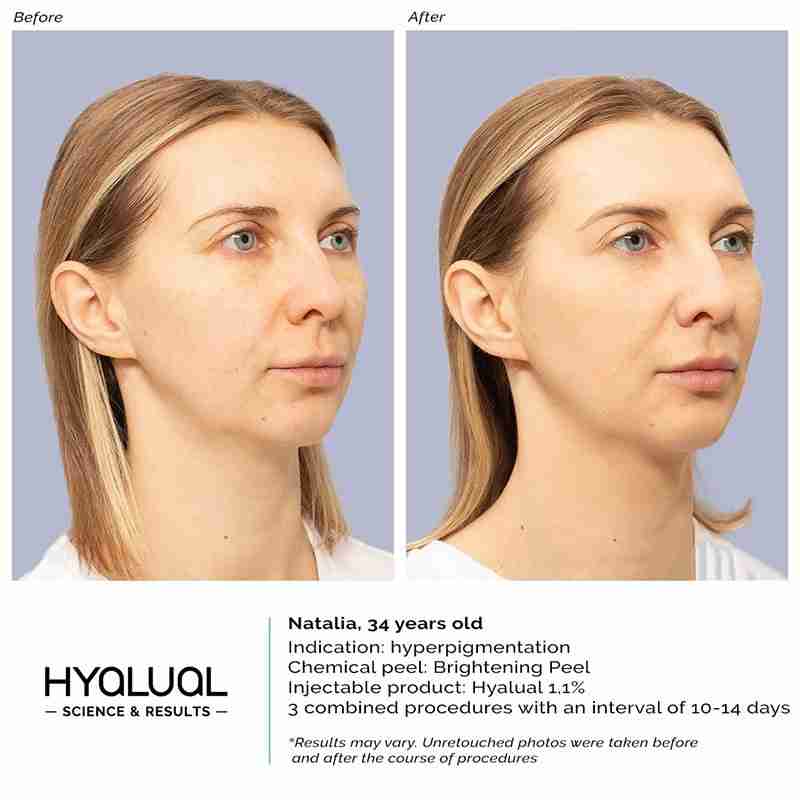 HYALUAL Brightening Peel