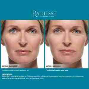 Radiesse with Lidocaine – Lifting & Volume Filler