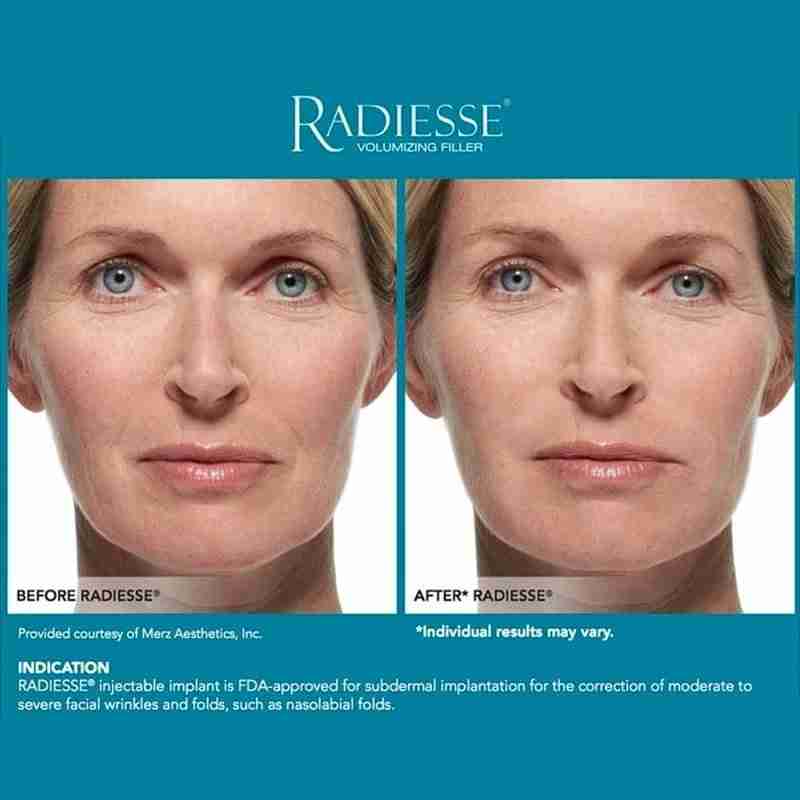 Radiesse with Lidocaine – Lifting & Volume Filler