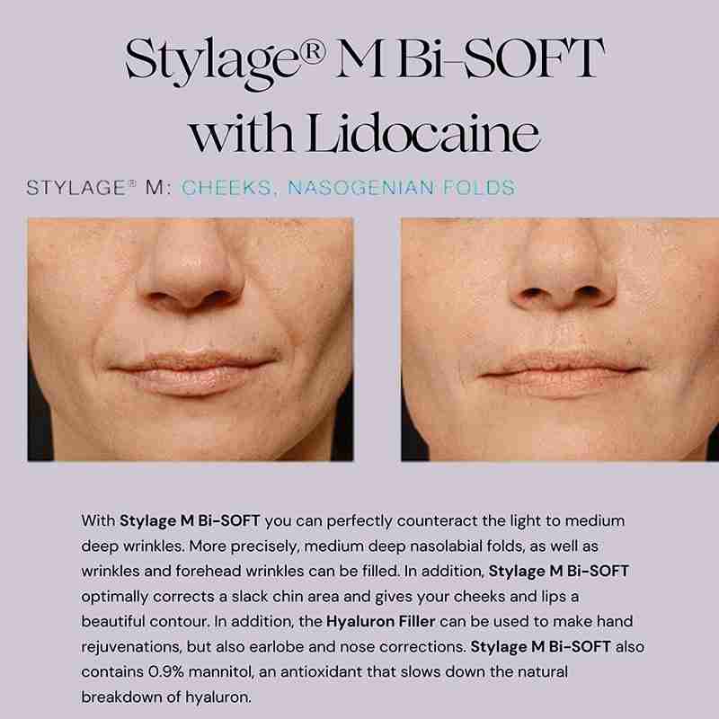 Stylage M with Lidocaine Bisoft Stylage M with Lidocaine Bisoft