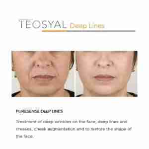 Teoxane Puresense Deeplines