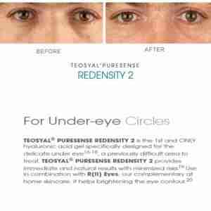 Teoxane Teosyal Redensity 2 Teoxane Teosyal Redensity 2