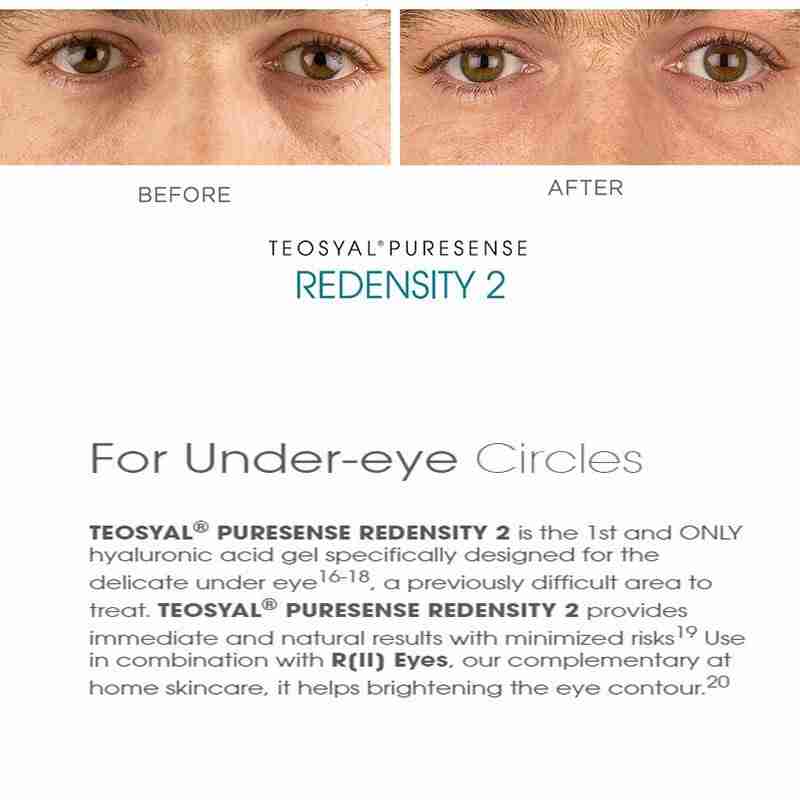 Teoxane Teosyal Redensity 2 Teoxane Teosyal Redensity 2