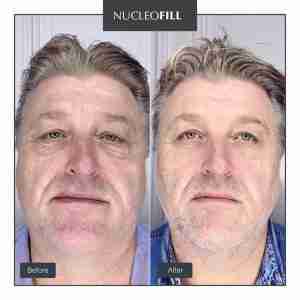 Nucleofill Age 1×2 ml Before After