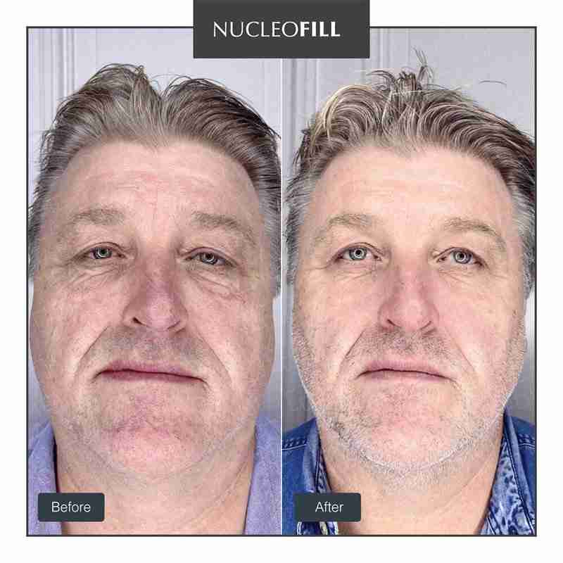 Nucleofill Age 1×2 ml Before After
