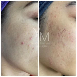 Biorepeal Before and After 6 - Skin on You Biorepeal Before and After