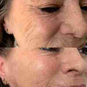 Profhilo Before and After Cheeks