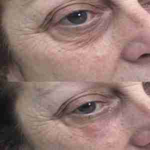 Jalupro Before and After Wrinkles