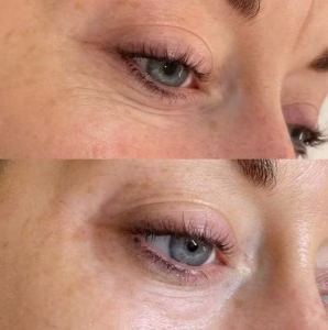 Jalupro Before and After Eyes