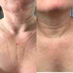 Jalupro Before and After Neck